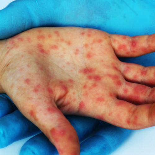 Tragedie în România: Un copil de doi ani nevaccinat a pierit de rujeolă, printre cele 15.000 de infectări și 6 decese în luna mai. Harta situației arată gravitatea epidemiei